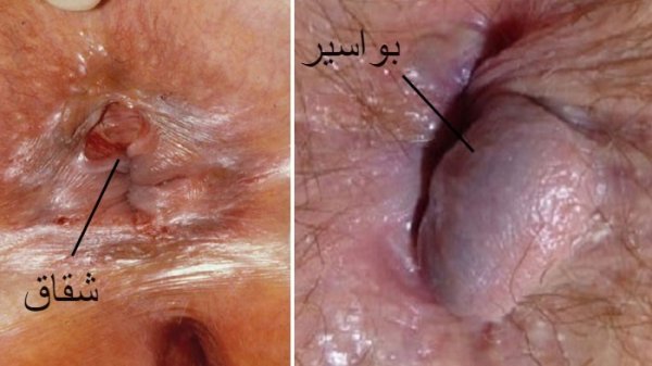  درمان شقاق واژینال+درمان شقاق مقعدی