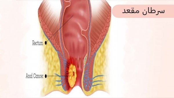 سرطان مقعدی چه علائمی دارد؟