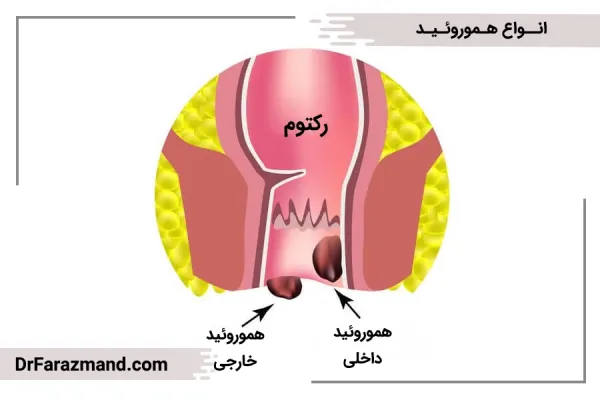  سرطان مقعدی چه علائمی دارد؟
