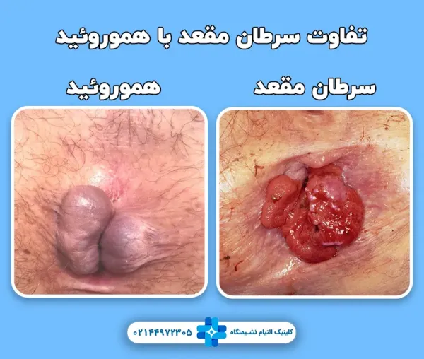  سرطان مقعدی چه علائمی دارد؟