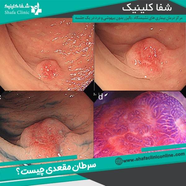  سرطان مقعدی چه علائمی دارد؟