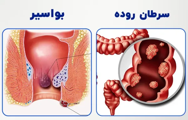 علائم سرطان بواسیر+علائم تومور مقعدی