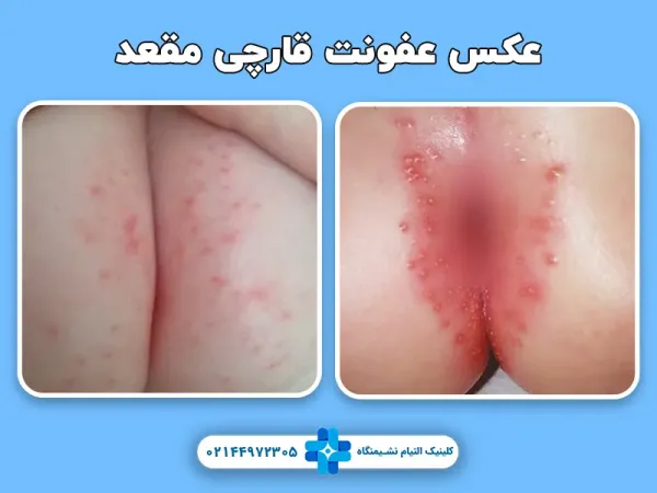  علائم سرطان بواسیر+علائم تومور مقعدی