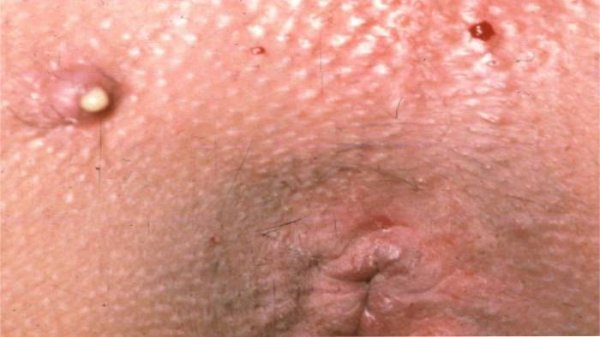  علائم سرطان بواسیر+علائم تومور مقعدی