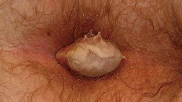  علائم سرطان بواسیر+علائم تومور مقعدی