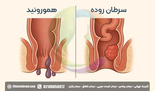  علائم سرطان بواسیر+علائم تومور مقعدی