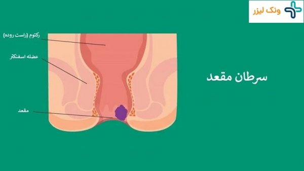 علائم سرطان بواسیر+علائم تومور مقعدی