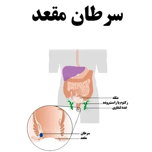  علائم سرطان بواسیر+علائم تومور مقعدی