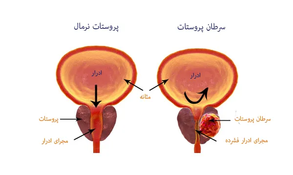  آیا رابطه جنسی زیاد باعث پروستات میشود؟