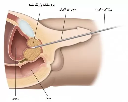  آیا رابطه جنسی زیاد باعث پروستات میشود؟