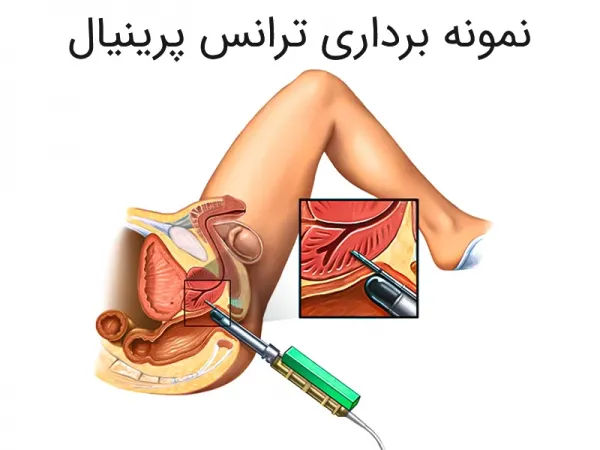  معاینه پروستات چگونه انجام میشود؟