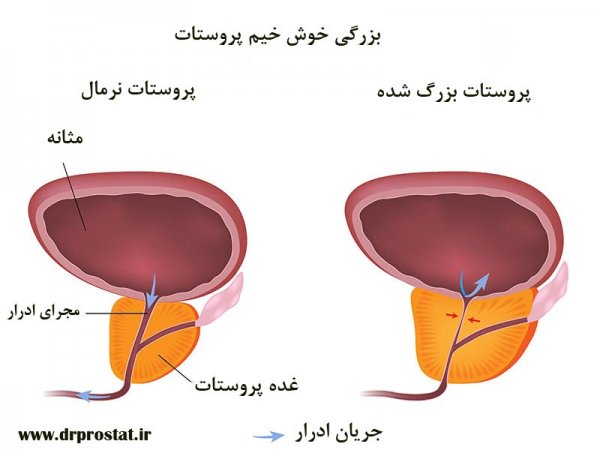  معاینه پروستات چگونه انجام میشود؟