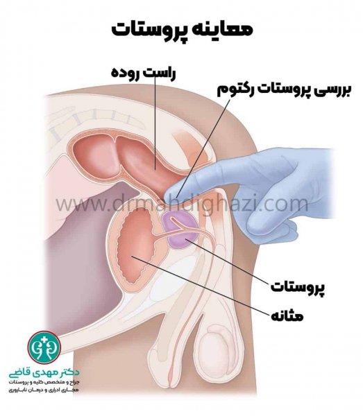  معاینه پروستات چگونه انجام میشود؟