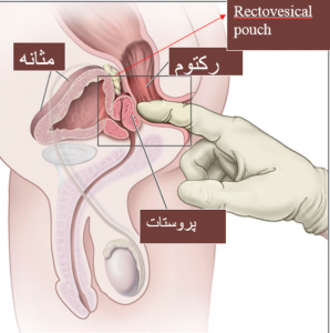  معاینه پروستات چگونه انجام میشود؟