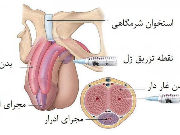  تجربه مردان از تزریق ژل به آلت تناسلی