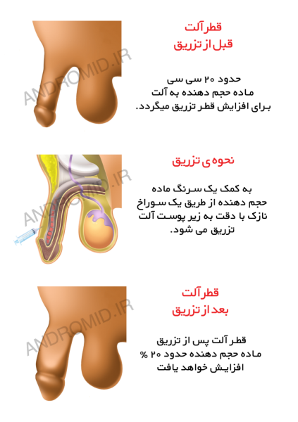 تجربه مردان از تزریق ژل به آلت تناسلی