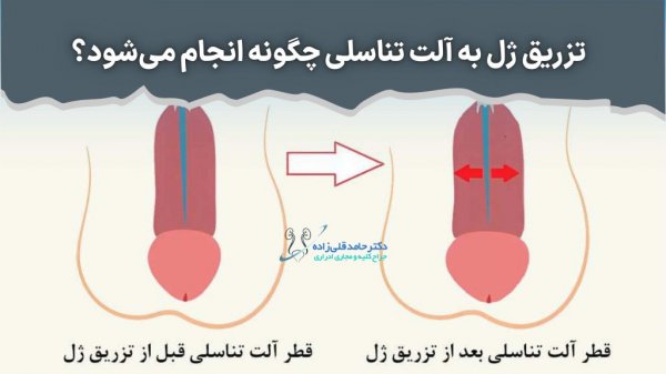  تجربه مردان از تزریق ژل به آلت تناسلی
