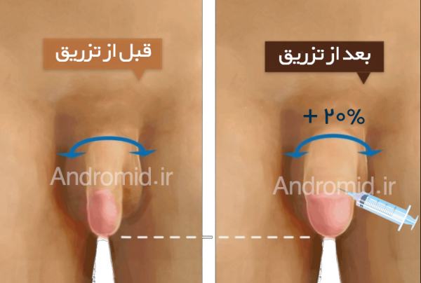  تجربه مردان از تزریق ژل به آلت تناسلی