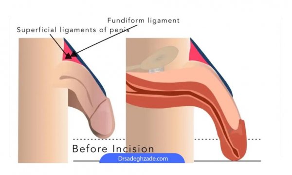 تجربه مردان از تزریق ژل به آلت تناسلی