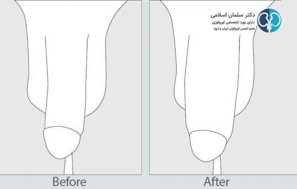  فیلم تزریق چربی به ناحیه تناسلی مردان + هزینه تزریق چربی به اندام تناسلی مردان