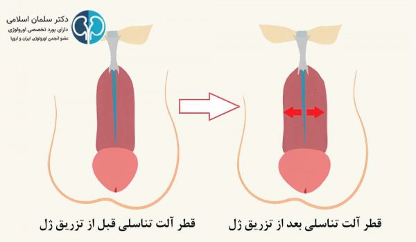  فیلم تزریق چربی به ناحیه تناسلی مردان + هزینه تزریق چربی به اندام تناسلی مردان