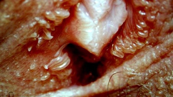  عکس وستیبولار پاپیلوماتوز + عکس پاپول مرواریدی زنانه