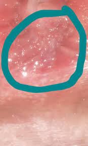  عکس وستیبولار پاپیلوماتوز + عکس پاپول مرواریدی زنانه