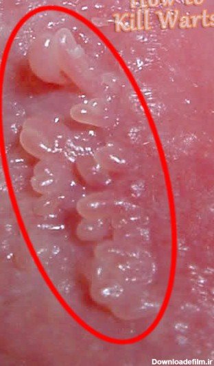  عکس وستیبولار پاپیلوماتوز + عکس پاپول مرواریدی زنانه