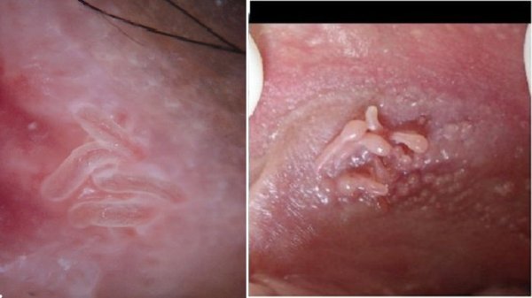  عکس وستیبولار پاپیلوماتوز + عکس پاپول مرواریدی زنانه