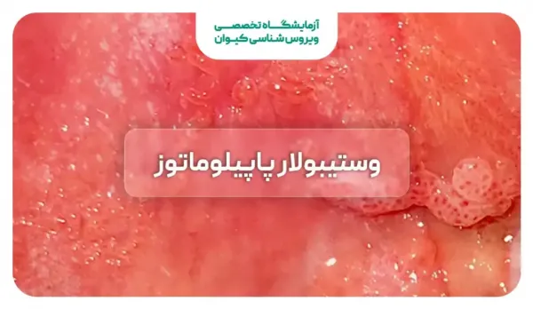  عکس وستیبولار پاپیلوماتوز + عکس پاپول مرواریدی زنانه