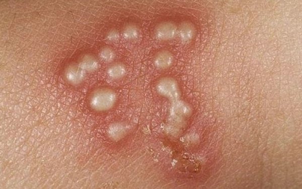  عکس وستیبولار پاپیلوماتوز + عکس پاپول مرواریدی زنانه