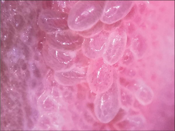  علائم پاپول مرواریدی زنانه