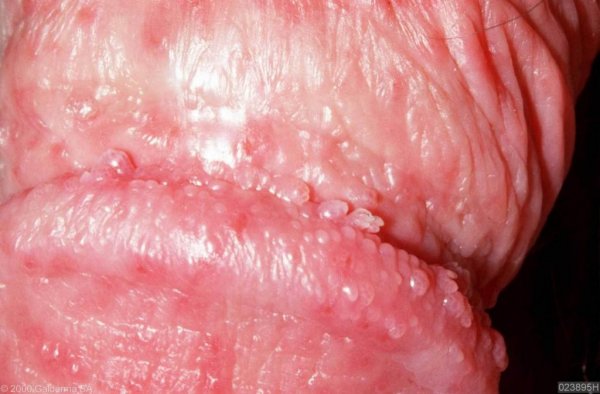  علائم پاپول مرواریدی زنانه