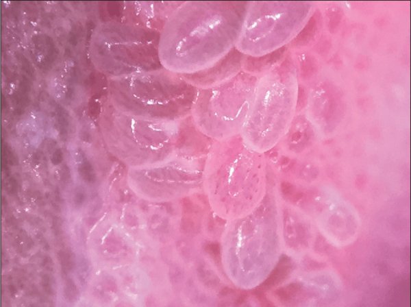  عکس وستیبولار پاپیلوماتوز در مردان