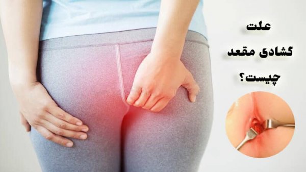 علت گشاد شدن روده بزرگ / گشاد شدن مقعد