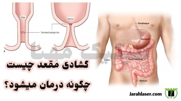  علت گشاد شدن روده بزرگ / گشاد شدن مقعد