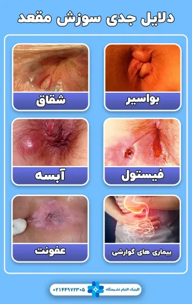 علت سوزش بعد از رابطه مقعدی / دخول از پشت