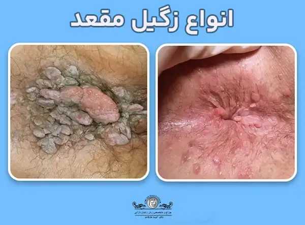 عکس زگیل مقعدی زنان + عکس زگیل مقعدی مردان