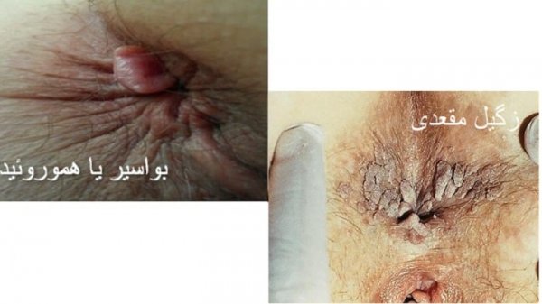  عکس زگیل مقعدی زنان + عکس زگیل مقعدی مردان