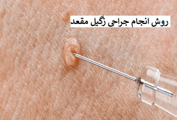  عکس زگیل مقعدی زنان + عکس زگیل مقعدی مردان