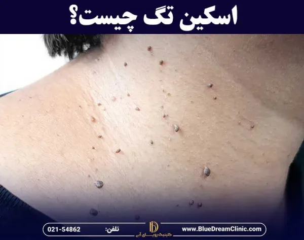 عکس اسکین تگ در زنان / منگوله پوستی