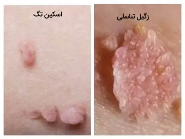  عکس اسکین تگ در زنان / منگوله پوستی