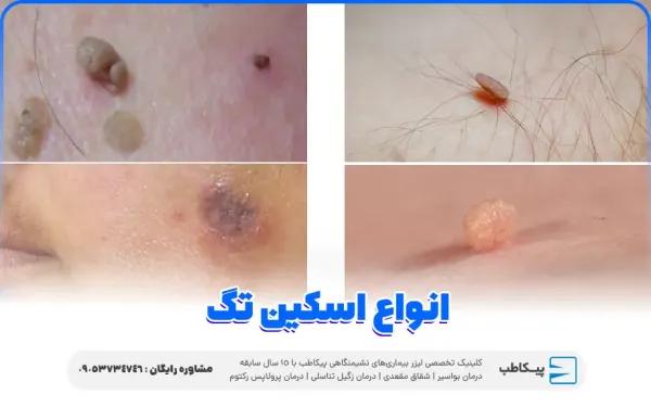  عکس اسکین تگ در زنان / منگوله پوستی