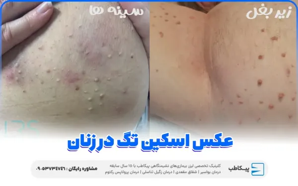  عکس اسکین تگ در زنان / منگوله پوستی