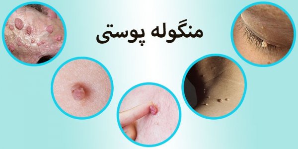  عکس اسکین تگ در زنان / منگوله پوستی
