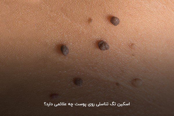  عکس اسکین تگ در زنان / منگوله پوستی