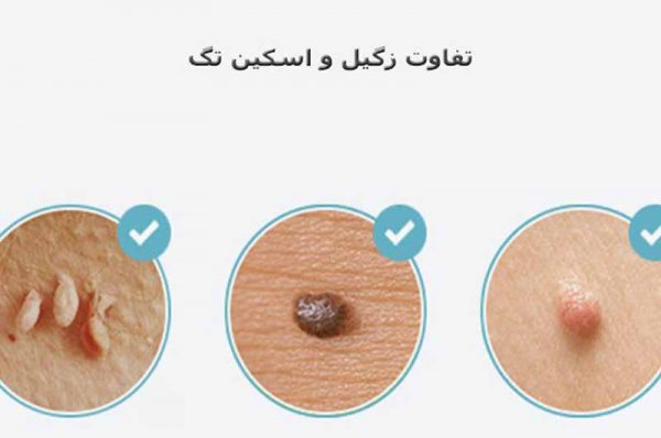  عکس اسکین تگ در زنان / منگوله پوستی
