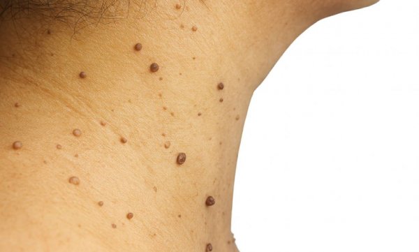  آیا منگوله پوستی / اسکین تگ خطرناک است؟