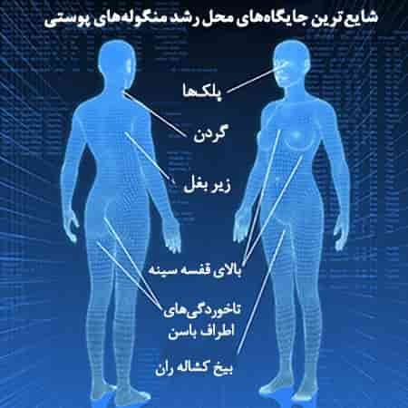  آیا منگوله پوستی / اسکین تگ خطرناک است؟