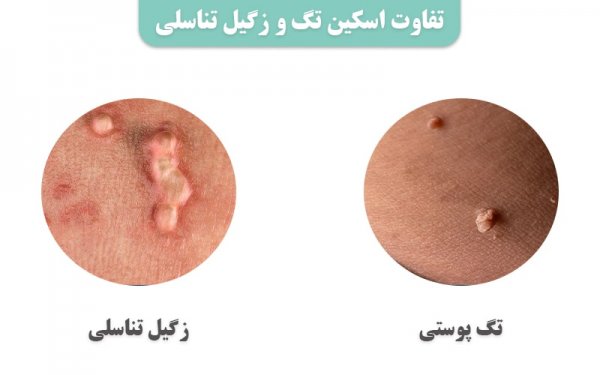  آیا منگوله پوستی / اسکین تگ خطرناک است؟